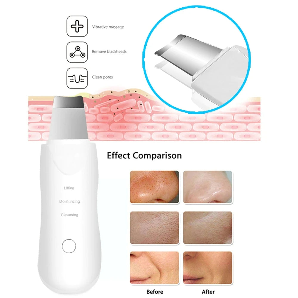 🧴 Electric Blackhead Pore Remover